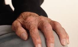 Pacientes con artritis reclaman sus derechos