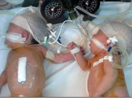 Las siameseas operadas con éxito en el Sanatorio San Lucas de San Isidro serán dadas de alta en los próximos días