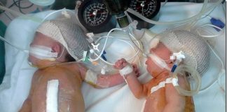 Las siameseas operadas con éxito en el Sanatorio San Lucas de San Isidro serán dadas de alta en los próximos días