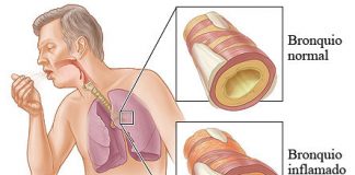 EPOC, una enfermedad con un elevado subdiagnóstico