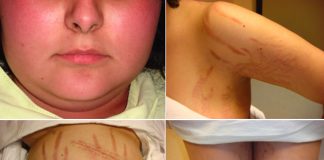 Aprobaron novedosa medicación para la enfermedad de Cushing