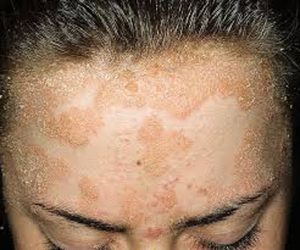 psoriasis 1