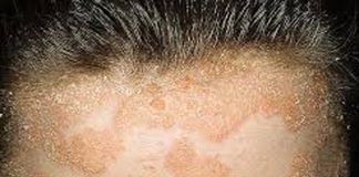 Artritis psoriásica: pacientes con psoriasis pueden desarrollarla