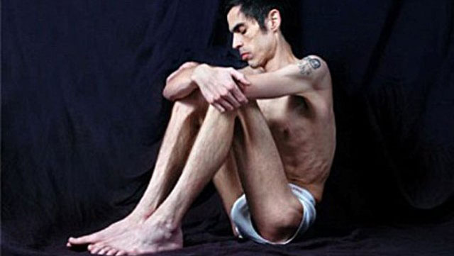 ANOREXIA EN HOMBRES