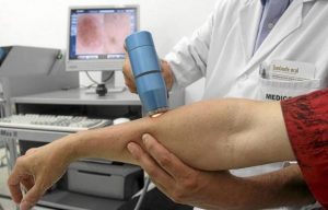MELANOMAAA