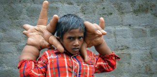Conocé la historia del niño “manos de gigante”