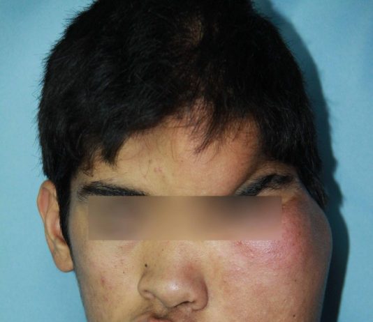 Exitosa cirugía de una malformación en el rostro en el Hospital Eva Perón