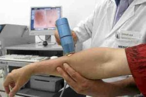 MELANOMA ---