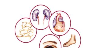 En San Isidro: curso sobre complicaciones microvasculares asociadas a la diabetes