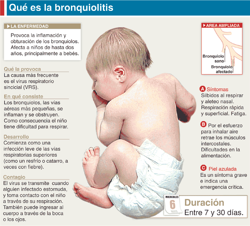 bronquiolitis4