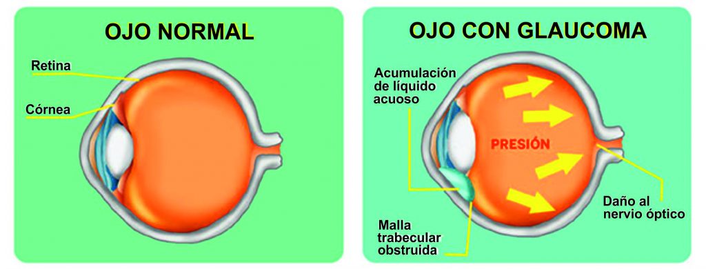 En Argentina padecen glaucoma más de un millón de personas