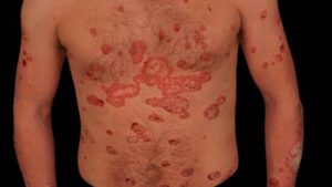 PSORIASIS 1