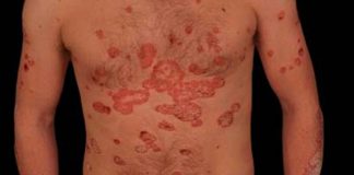 Psoriasis: el desafío de desestigmatizar esta enfermedad de la piel