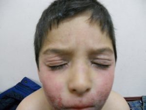 dermatitis-3