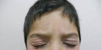 Dermatitis atópica: cuándo consultar al especialista