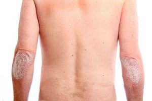 Psoriasis Causas