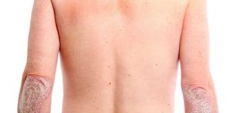 Psoriasis: detección temprana y tratamientos para mejorar la calidad de vida