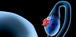Cáncer de ovario: tendría su origen en las trompas de Falopio