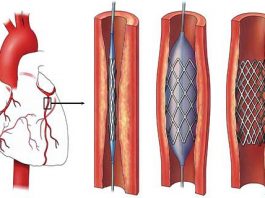 Más de 75 stents se colocan por día en Argentina