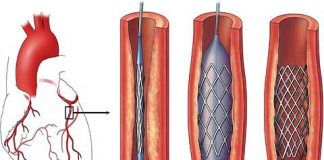 Más de 75 stents se colocan por día en Argentina