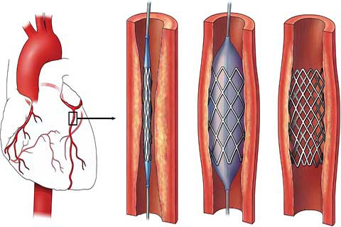 Más de 75 stents se colocan por día en Argentina
