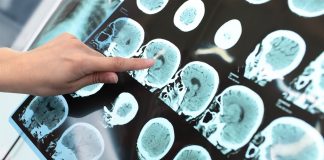 Esclerosis Múltiple: la relación con factores ambientales y hábitos de vida