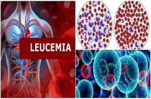 leucemia-665x285