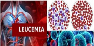 Leucemia: nuevo tratamiento logra remisión en 9 de cada 10 pacientes