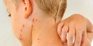 Unicef, alarmada por resurgimiento del sarampión en el mundo