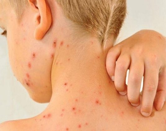 Unicef, alarmada por resurgimiento del sarampión en el mundo