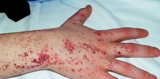 Enfermedad de Fabry: solo 3 de cada 10 pacientes tienen diagnóstico certero