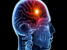 La demencia vascular puede ser prevenida con hábitos saludables