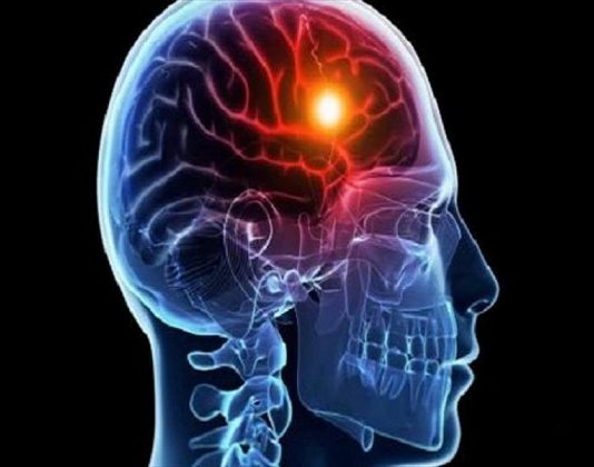 La demencia vascular puede ser prevenida con hábitos saludables