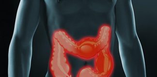 Aumenta la Enfermedad Inflamatoria Intestinal