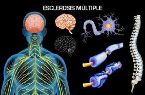 esclerosis-1140x650