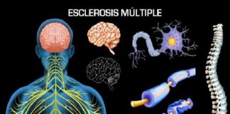 Todos las formas de Esclerosis Múltiple tienen tratamiento