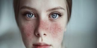 Día Mundial del Lupus, lo que tenés que saber