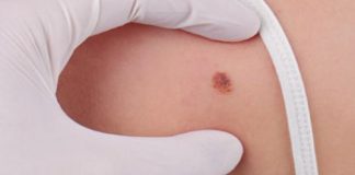 Campaña para informar sobre el melanoma, el cáncer de piel más agresivo