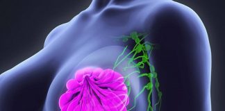 Una droga extiende la vida de mujeres jóvenes con un tipo de cáncer de mama en estadio avanzado