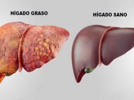 El Hígado Graso es considerado la epidemia del siglo XXI