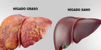 El Hígado Graso es considerado la epidemia del siglo XXI