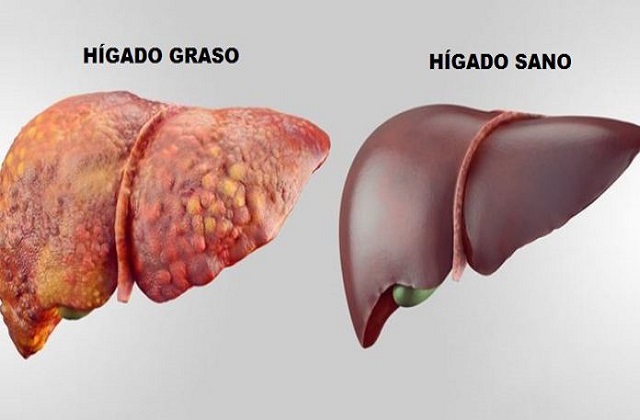 Hígado-graso-696x383
