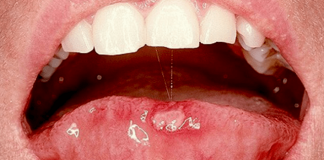 Cáncer Bucal: La detección precoz, clave para controlar la enfermedad