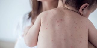 Sarampión: los bebés de 6 a 11 meses deben recibir una dosis extra de vacuna triple viral