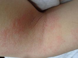 Novedades en el tratamiento de la Dermatitis Atópica