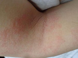 _dermatitisatopica