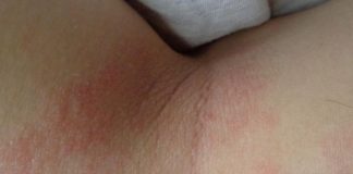 Novedades en el tratamiento de la Dermatitis Atópica