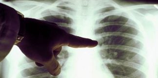 Retirarían del PMO una droga que reduce el riesgo de muerte por cáncer de pulmón