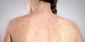 El sarampión produce ‘amnesia inmune’ y deja al cuerpo expuesto a infecciones