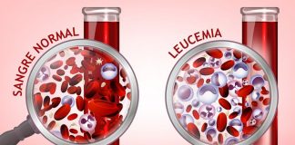 Piden que el COVID-19 no invisibilice a las personas con leucemia